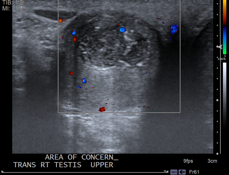 Testicular Epidermoid Cyst Image