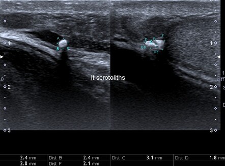 Scrotal pearls | Image | Radiopaedia.org