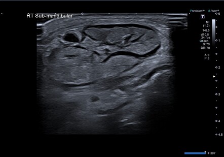 Iodide mumps | Radiology Reference Article | Radiopaedia.org