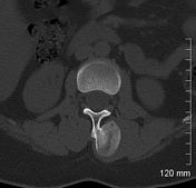 Vertebral lesion (differential) | Radiology Reference Article ...