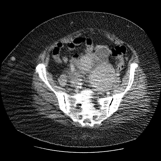 Diffuse Peritoneal Leiomyomatosis Image 