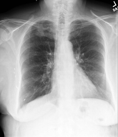 Right upper lobe lung cancer obscured by the first rib | Radiology Case ...