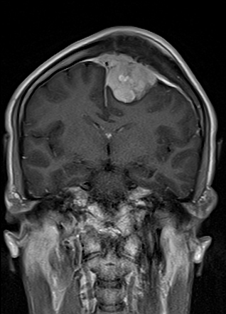 Meningioma With Dural Venous Sinus Invasion | Radiology Case ...