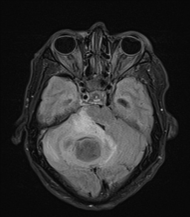 Otogenic cerebellar abscesses | Radiology Case | Radiopaedia.org