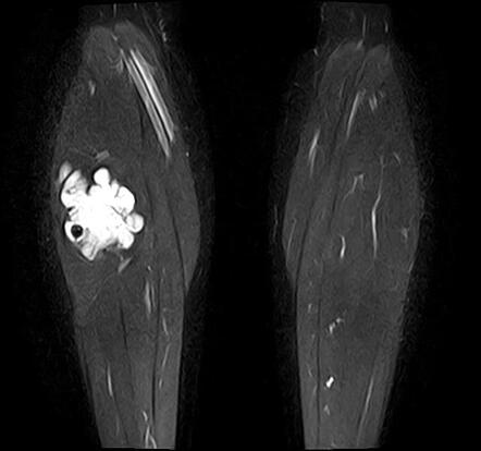 Intramuscular haemangioma | Radiology Case | Radiopaedia.org