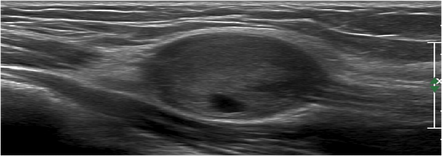 Jupiter cyclone appearance of nerve sheath tumor | Radiology Case ...