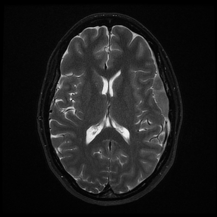 Dural lymphoma | Image | Radiopaedia.org