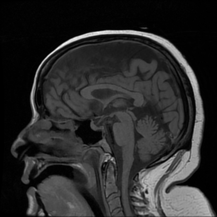 Lymphoma - intravascular | Image | Radiopaedia.org