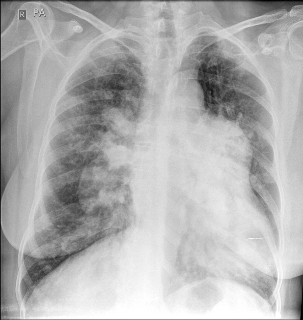 Egg and banana sign (pulmonary hypertension), Radiology Reference Article