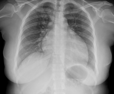 Postpartum cardiomyopathy | Radiology Case | Radiopaedia.org