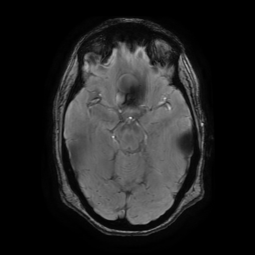 Supraclinoid ICA aneurysm | Image | Radiopaedia.org