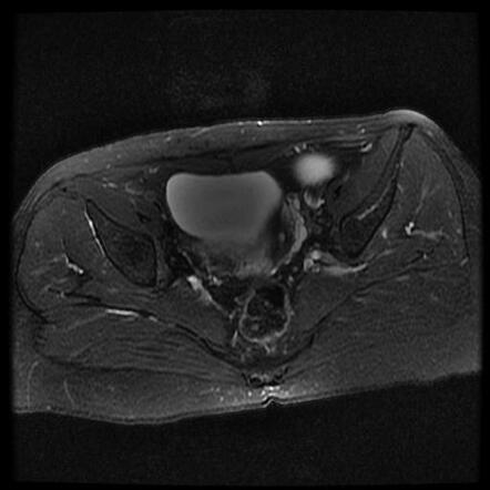 Hydrosalpinx (MRI) | Image | Radiopaedia.org