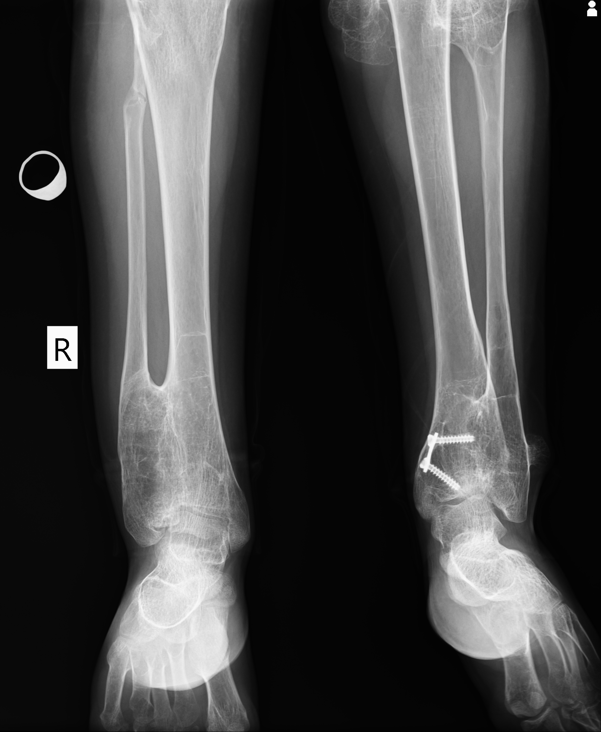 Diaphyseal aclasis | Image | Radiopaedia.org