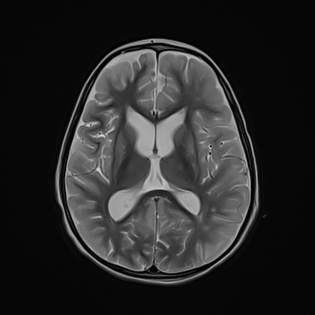 Propionic acidemia | Radiology Reference Article | Radiopaedia.org