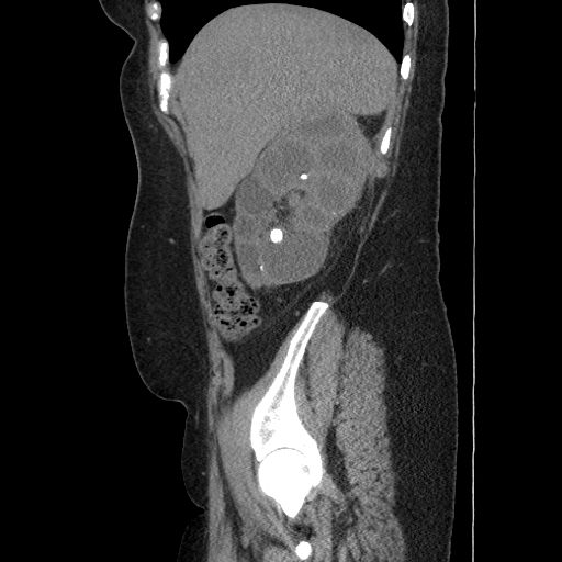 Xanthogranulomatous Pyelonephritis | Image | Radiopaedia.org