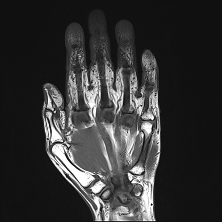 Normal right hand MRI | Radiology Case | Radiopaedia.org