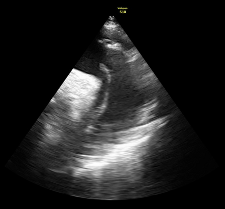 Aortic Dissection Radiology Reference Article Radiopaedia Org