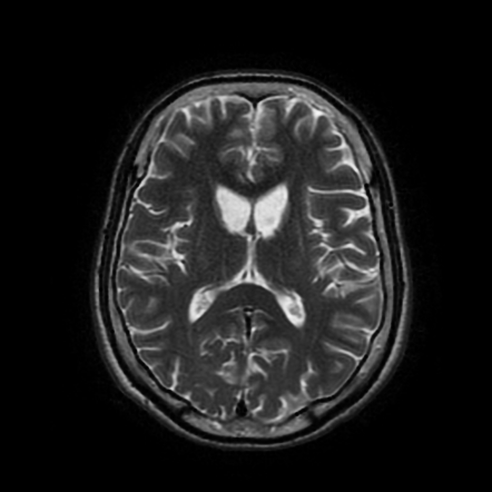 Huntington disease | Radiology Case | Radiopaedia.org