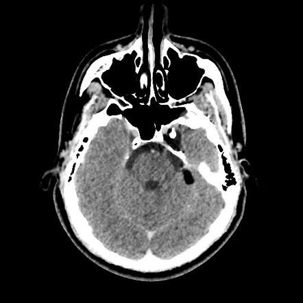 Ruptured dermoid cyst - cavernous sinus | Radiology Case | Radiopaedia.org