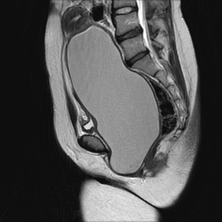 Hematocolpos | Radiology Case | Radiopaedia.org