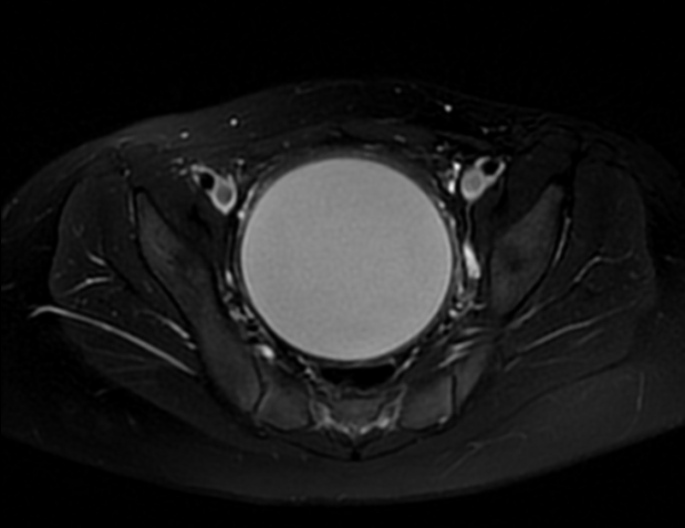 Hematocolpos Image Radiopaedia Org