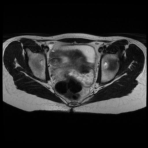 Botryoid rhabdomyosarcoma | Image | Radiopaedia.org