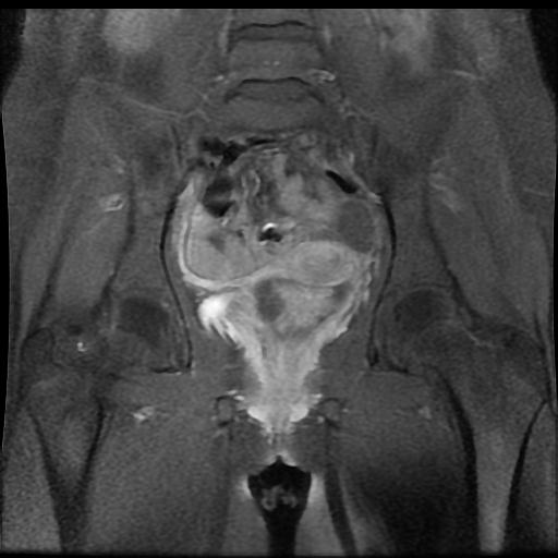 Botryoid rhabdomyosarcoma | Image | Radiopaedia.org