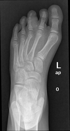 Soft tissue venous malformation (hemangioma) - foot | Radiology Case ...