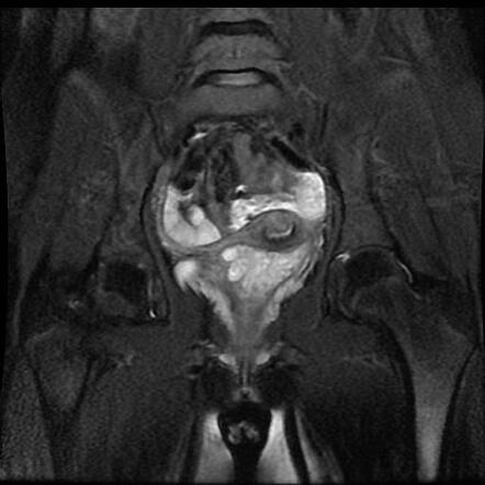 Botryoid rhabdomyosarcoma | Image | Radiopaedia.org