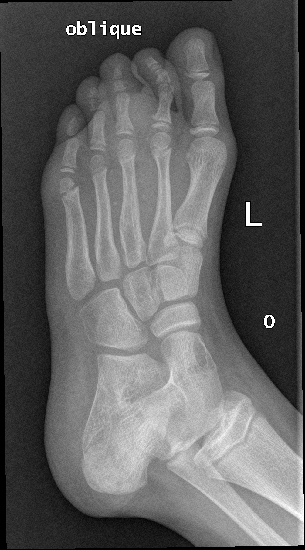 Soft tissue venous malformation (hemangioma) - foot | Image ...