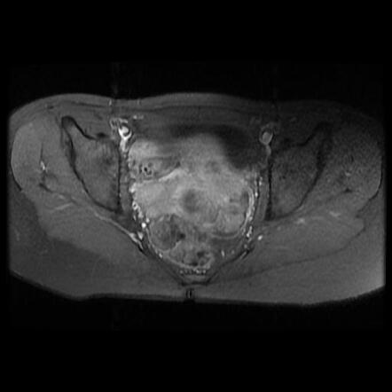 Botryoid rhabdomyosarcoma | Image | Radiopaedia.org