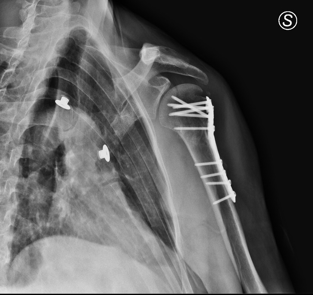 Stress shielding in proximal tibia of a stemmed prosthesis  PDF