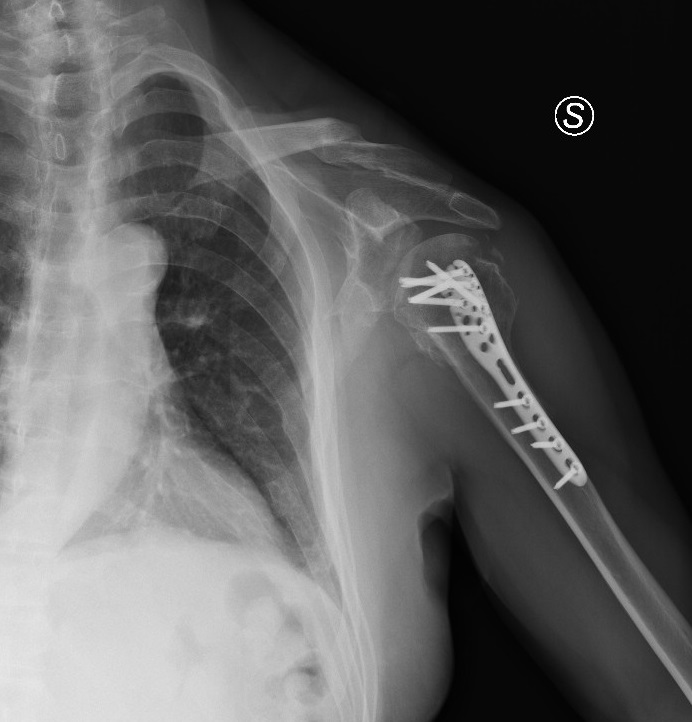 Stress shielding after osteosynthesis humeral head displaced fracture ...