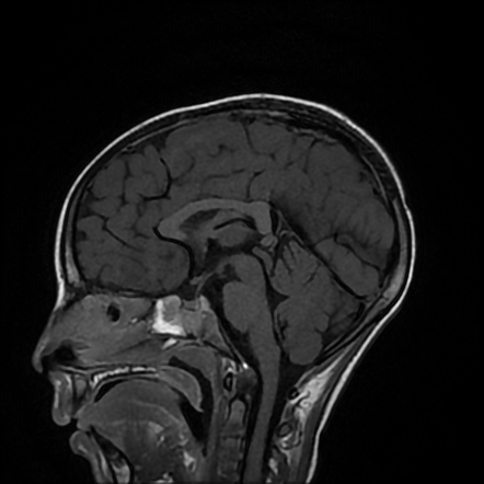 Acute Disseminated Encephalomyelitis | Image | Radiopaedia.org