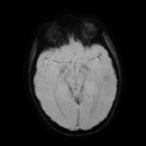 Acute Disseminated Encephalomyelitis | Image | Radiopaedia.org