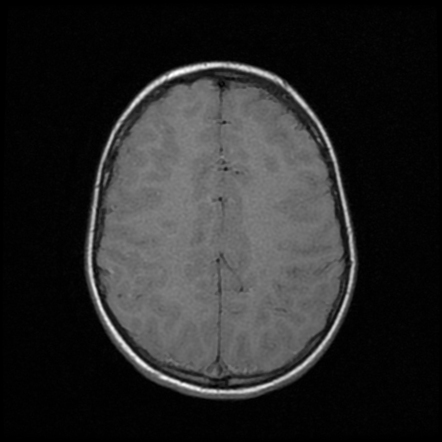 Acute Disseminated Encephalomyelitis | Image | Radiopaedia.org