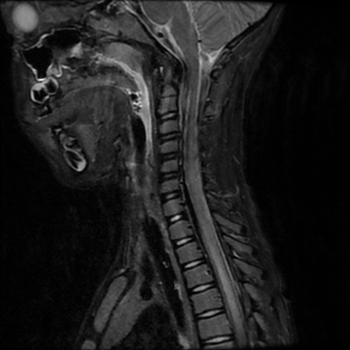 Acute disseminated encephalomyelitis | Image | Radiopaedia.org