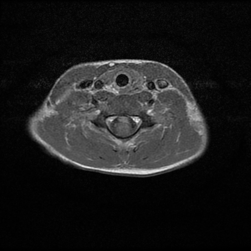 Acute Disseminated Encephalomyelitis | Image | Radiopaedia.org