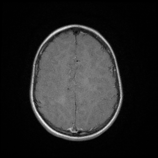 Acute disseminated encephalomyelitis | Image | Radiopaedia.org