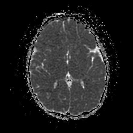 Acute Disseminated Encephalomyelitis | Image | Radiopaedia.org