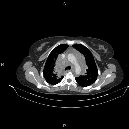 hodgkin's lymphoma case study