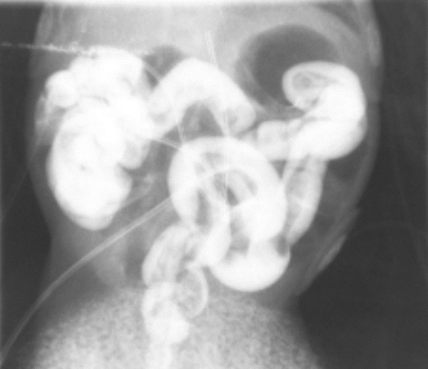 Meconium Plug Syndrome Image