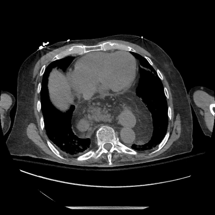 Large hiatal hernia | Radiology Case | Radiopaedia.org