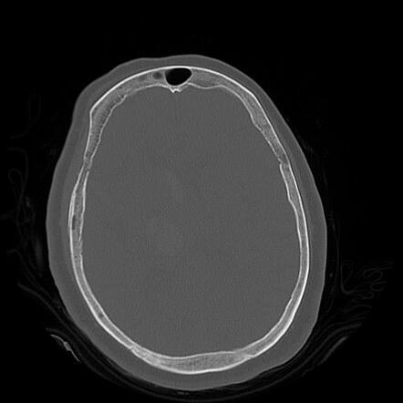 Thalamic hemorrhage with intraventricular extension | Image ...