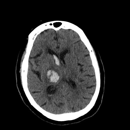 Thalamic Hemorrhage With Intraventricular Extension 