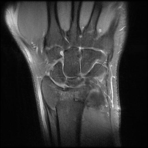 Volar intercalated segmental instability (VISI) | Image | Radiopaedia.org