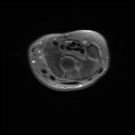 Volar intercalated segmental instability (VISI) | Radiology Case ...