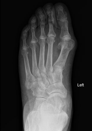 Jones and pseudo-Jones fractures | Image | Radiopaedia.org