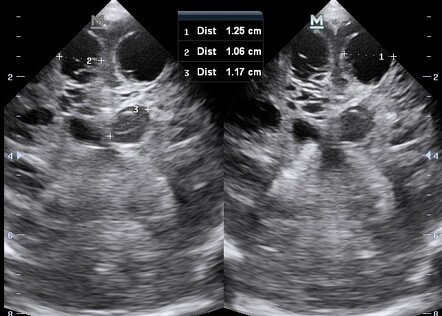 Grade IV periventricular leukomalacia | Radiology Case | Radiopaedia.org