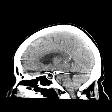 Posterior limb internal capsule infarct after MCA aneurysm coiling ...